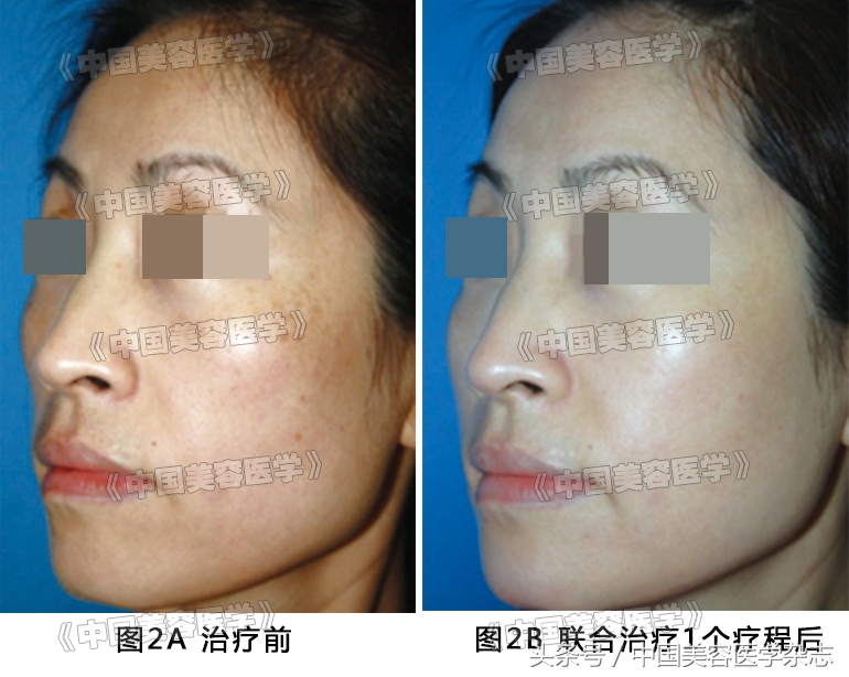 去褐斑最有效的偏方,祛褐斑最好的中成药