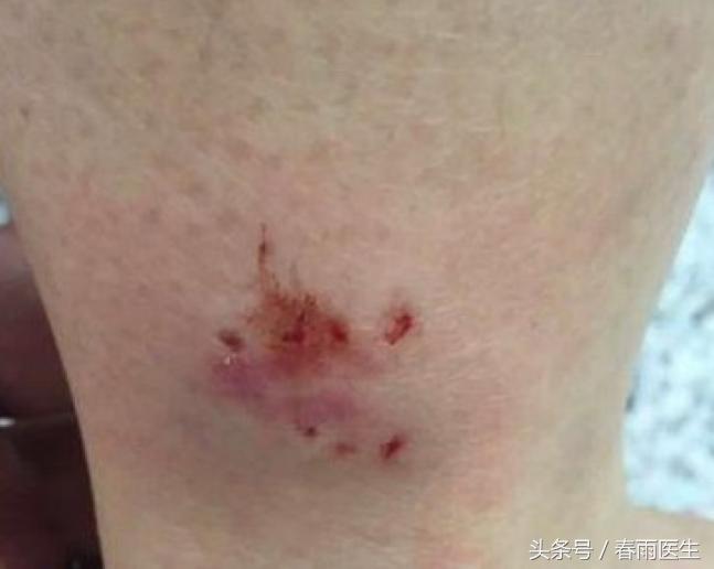 被人咬了，除了让TA赔钱，你还必须这么做！