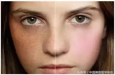 去褐斑最有效的偏方,祛褐斑最好的中成药