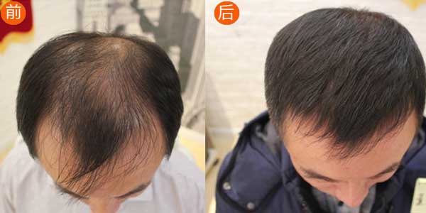 涨点姿势！做完植发，效果能维持时间？