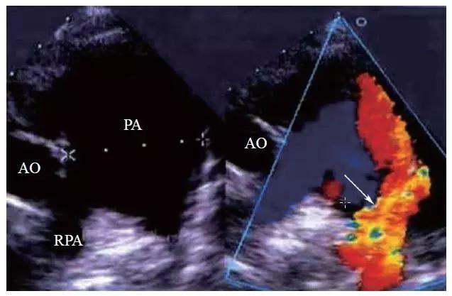 超声主动脉瓣重度狭窄,主动脉弓闭锁