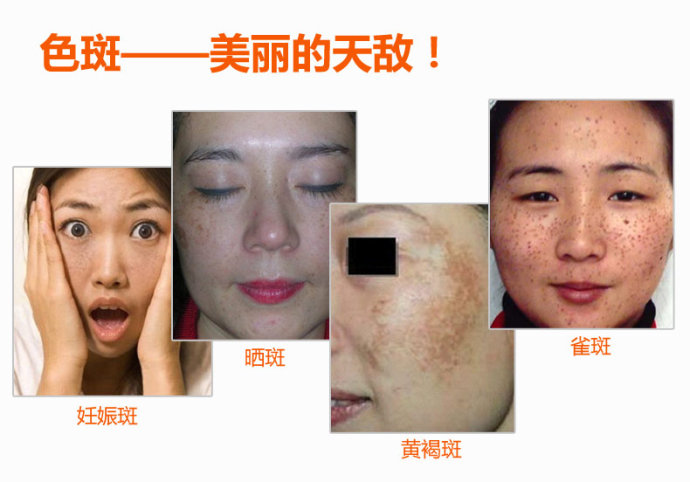 长雀斑要注意的事项,10个防晒小攻略让你告别雀斑