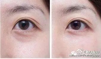 怎么区分眼袋黑眼圈泪沟卧蚕,卧蚕眼袋泪沟黑眼圈