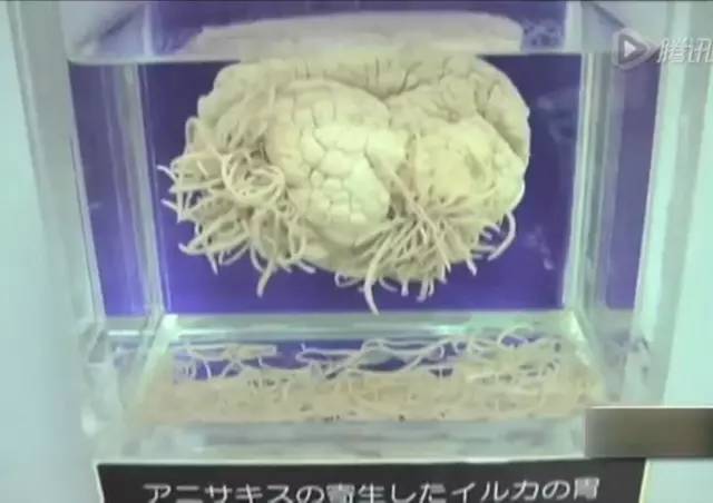 男子身体养虫,河南男子体内长虫