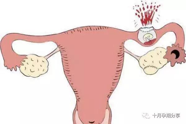 宫外孕打杀胚胎的针会导致不孕吗,宫外孕有哪些症状会引起不孕