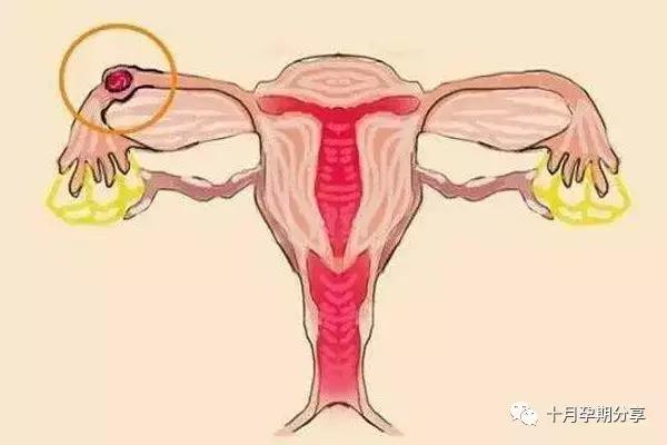 宫外孕打杀胚胎的针会导致不孕吗,宫外孕有哪些症状会引起不孕