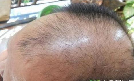 脱发饮食调料,黑芝麻酱治脱发