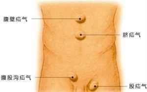 疝气有什么症状手术风险大吗,如何治疗与预防疝气