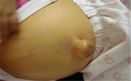 疝气有什么症状手术风险大吗,如何治疗与预防疝气