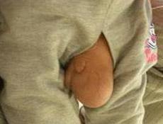 疝气有什么症状手术风险大吗,如何治疗与预防疝气