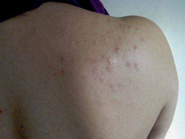 夏天湿气重的症状和表现,民间说身体湿气太重怎样除掉