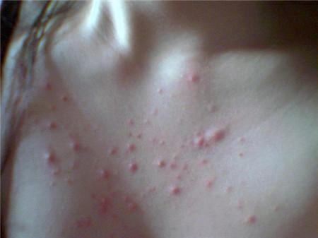 夏天湿气重的症状和表现,民间说身体湿气太重怎样除掉