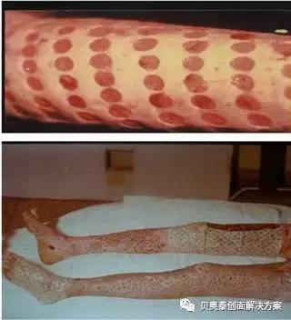 烧伤的治疗,烧伤的治疗土方