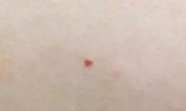 出现小红痣不痛不痒,60岁身上现小红痣是什么原因