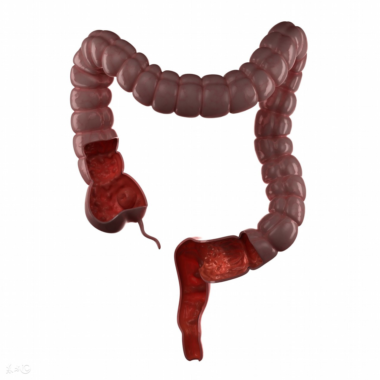 得了结肠炎会暴瘦吗,得了结肠炎是什么症状