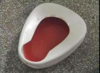 不同颜色的尿液所代表的疾病汇总,尿液颜色对照7种身体状况