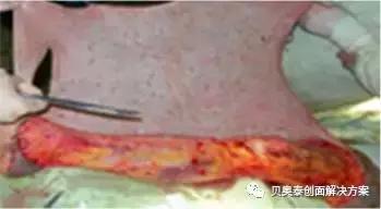 烧伤的治疗,烧伤的治疗土方