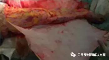 烧伤的治疗,烧伤的治疗土方