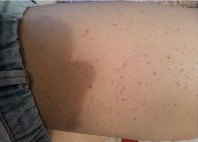 身上有小红痣不痛不痒是怎么回事,人到中年身上长小红痣是什么原因