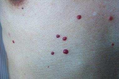 身上有小红痣不痛不痒是怎么回事,人到中年身上长小红痣是什么原因