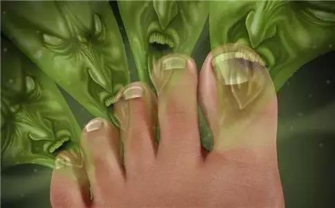 混合型脚气最难治吗,水泡型脚气和糜烂型脚气哪种难治