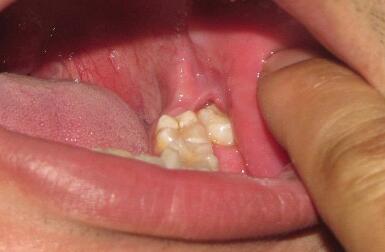 牙疼为什么会引发败血症,牙疼引起败血症前兆