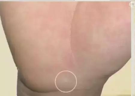 手上发紫中间发白,手上发紫发青还发痒是怎么回事