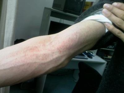 湿疹的根源在哪里怎样才能根治,湿疹怎么治疗不留后遗症