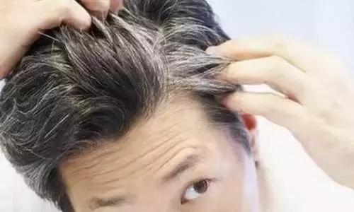 容易长白头是什么原因,几种人容易得白头发