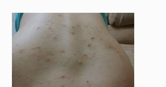 湿疹的根源在哪里怎样才能根治,湿疹怎么治疗不留后遗症