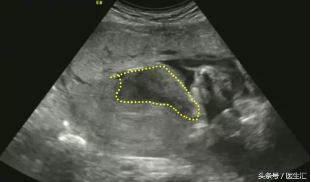 胎盘早剥是什么导致的,胎盘早剥是什么原因导致的胎儿肺炎