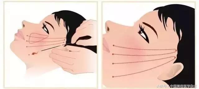 小切口线雕面部提升术视频,线雕面部提升术危害