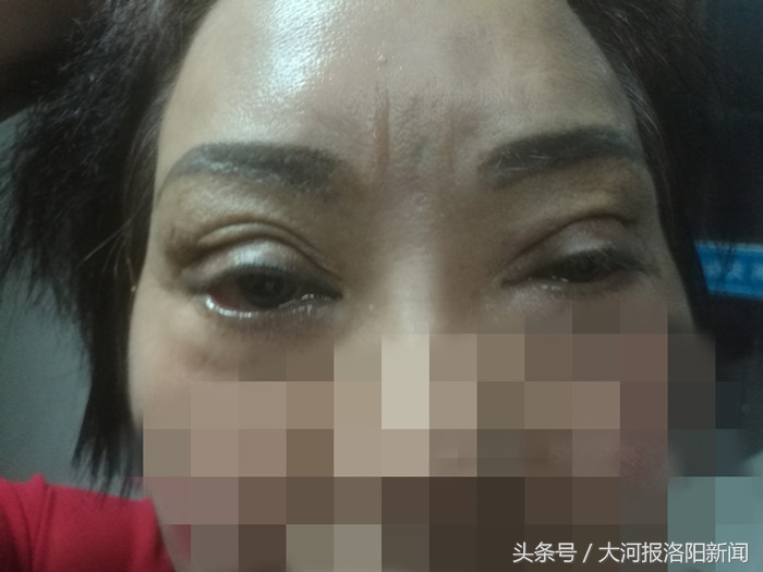 双眼皮修复整形内幕,双眼皮修复协和谁做的好