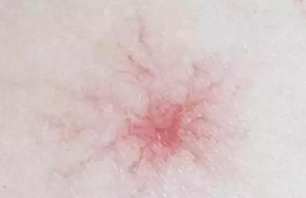 红痣的出现民间意味着什么,突然冒出来的红色痣怎么处理