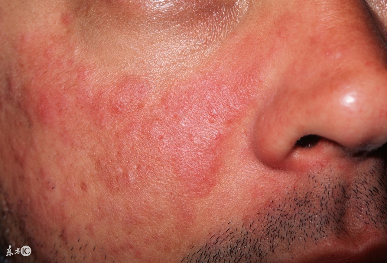 红斑狼疮怎么样算稳定期,红斑狼疮临床表现记忆口诀