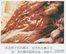 子宫内膜炎最佳运动,牛的子宫内膜炎怎么治