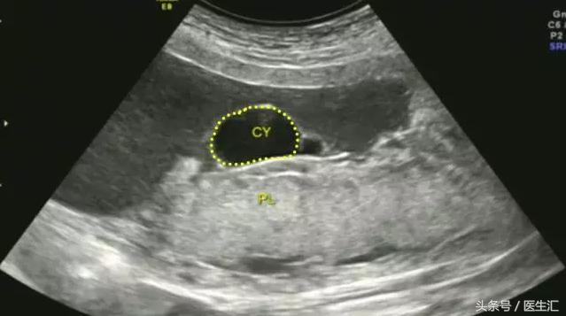 胎盘早剥是什么导致的,胎盘早剥是什么原因导致的胎儿肺炎