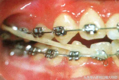牙齿矫正的过程能参加篮球比赛吗,牙齿矫正过程中掉了可以找医院吗