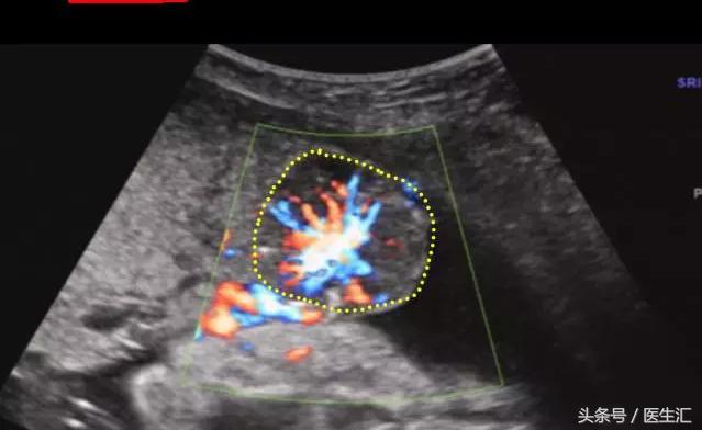 胎盘早剥是什么导致的,胎盘早剥是什么原因导致的胎儿肺炎