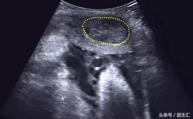 胎盘早剥是什么导致的,胎盘早剥是什么原因导致的胎儿肺炎