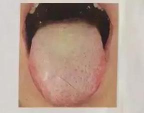 咽炎异物感白痰多吃什么药,咽炎咽部异物感痰多吐痰