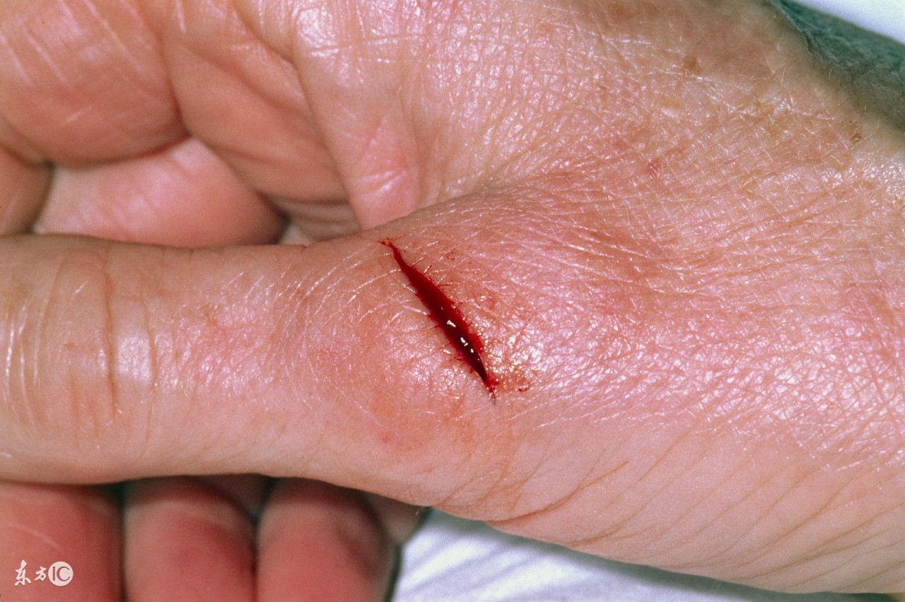 感染破伤风的伤口的特征有哪些,破伤风得扎多深才易得破伤风