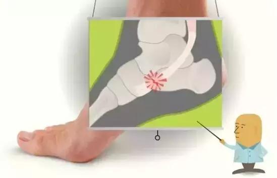 平时崴脚的处理方式,以前崴脚后平地崴脚