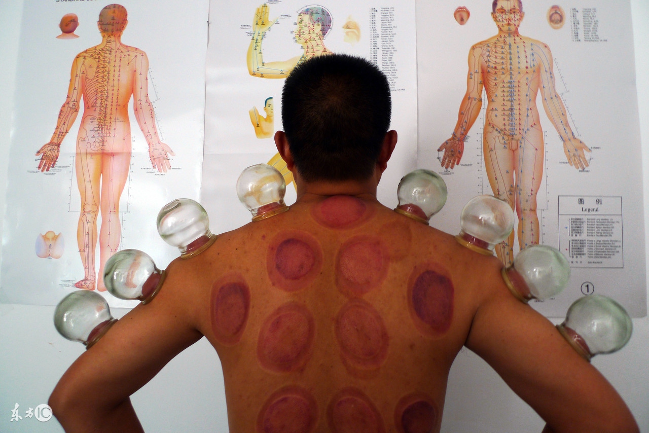 体内湿气大拔罐还是刮痧,拔罐祛除体内湿气位置图