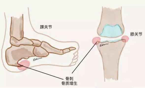 骨质增生骨刺怎么治疗能根除,骨质增生怎么治才能彻底治好骨刺