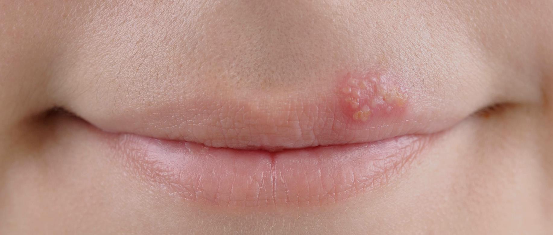 嘴唇红肿起泡怎么回事,嘴唇起泡最快消除方法