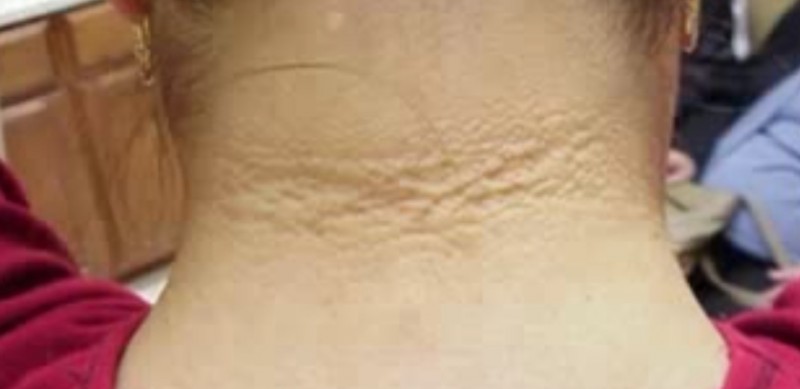 脖子后面有黑色纹路怎么回事,脖子上的纹路像脏的一样怎么回事