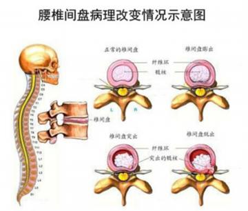 腰椎间盘膨出突出和脱出的区别,腰椎间盘突出膨出脱出哪个更严重