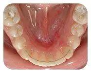 矫正后戴保持器需要多长时间,矫正保持器需要终身佩戴吗