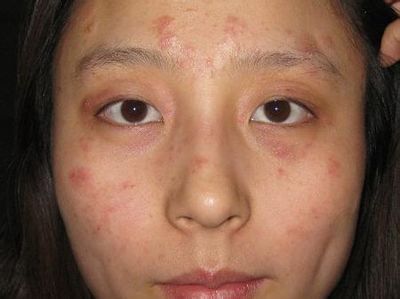 容易长湿疹教你3个方法赶走湿疹,患了湿疹怎么办教你一招简单高效